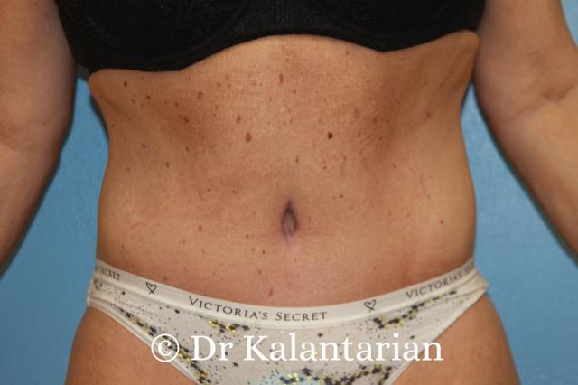 Tummy Tuck after at Dr Kalantarian (Dr K) Plastic Surgery Orange County in Irvine, CA