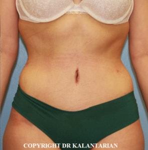 Tummy Tuck after at Dr Kalantarian (Dr K) Plastic Surgery Orange County in Irvine, CA