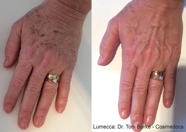 Morpheus8 result at Willis Cosmetic Surgery & MedSpa in Ellisville, MO