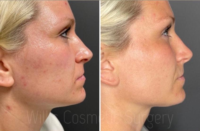 Willis Cosmetic Surgery & MedSpa morpheus8 result — Ellisville, MO