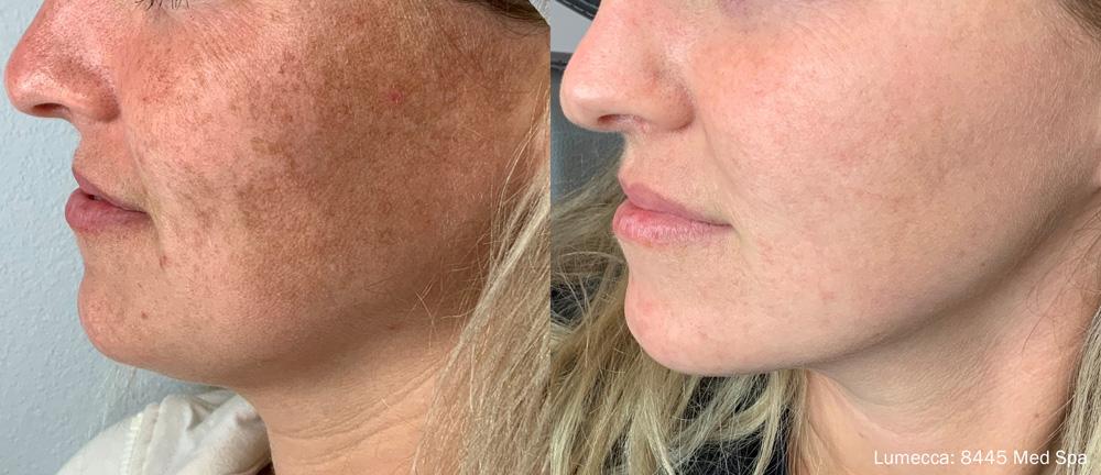 Willis Cosmetic Surgery & MedSpa laser treatment result — Ellisville, MO
