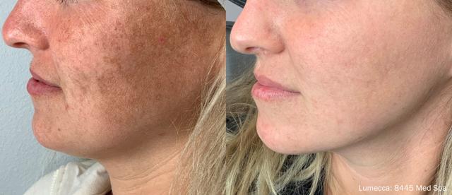 Laser Skin Resurfacing result at Willis Cosmetic Surgery & MedSpa in Ellisville, MO
