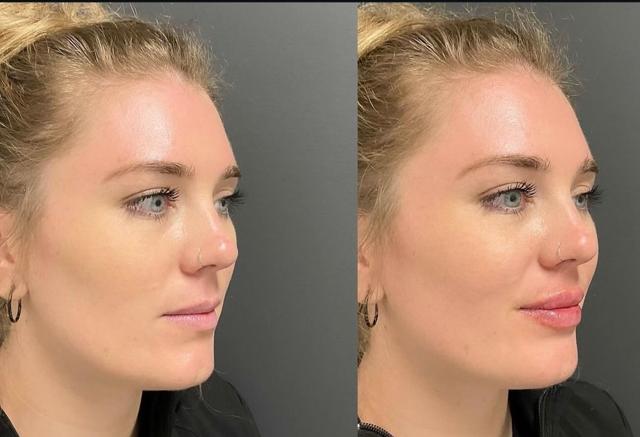 Lip Filler result at Willis Cosmetic Surgery & MedSpa in Ellisville, MO