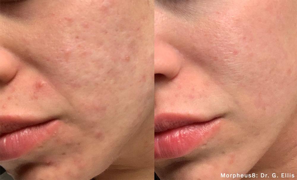 Willis Cosmetic Surgery & MedSpa microneedling result — Ellisville, MO