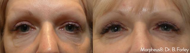 Microneedling result at Willis Cosmetic Surgery & MedSpa in Ellisville, MO