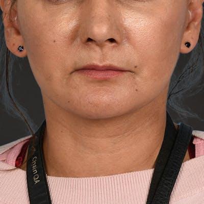 Blepharoplasty after at Cheng Plastic Surgery in Saratoga, CA