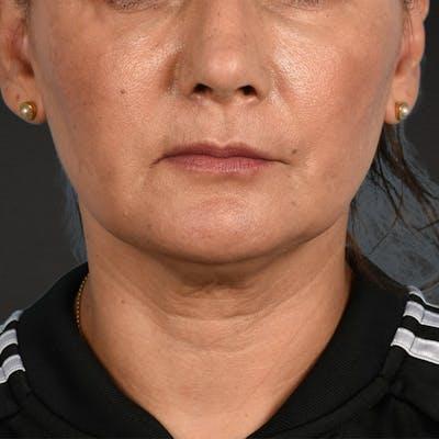 Blepharoplasty before at Cheng Plastic Surgery in Saratoga, CA