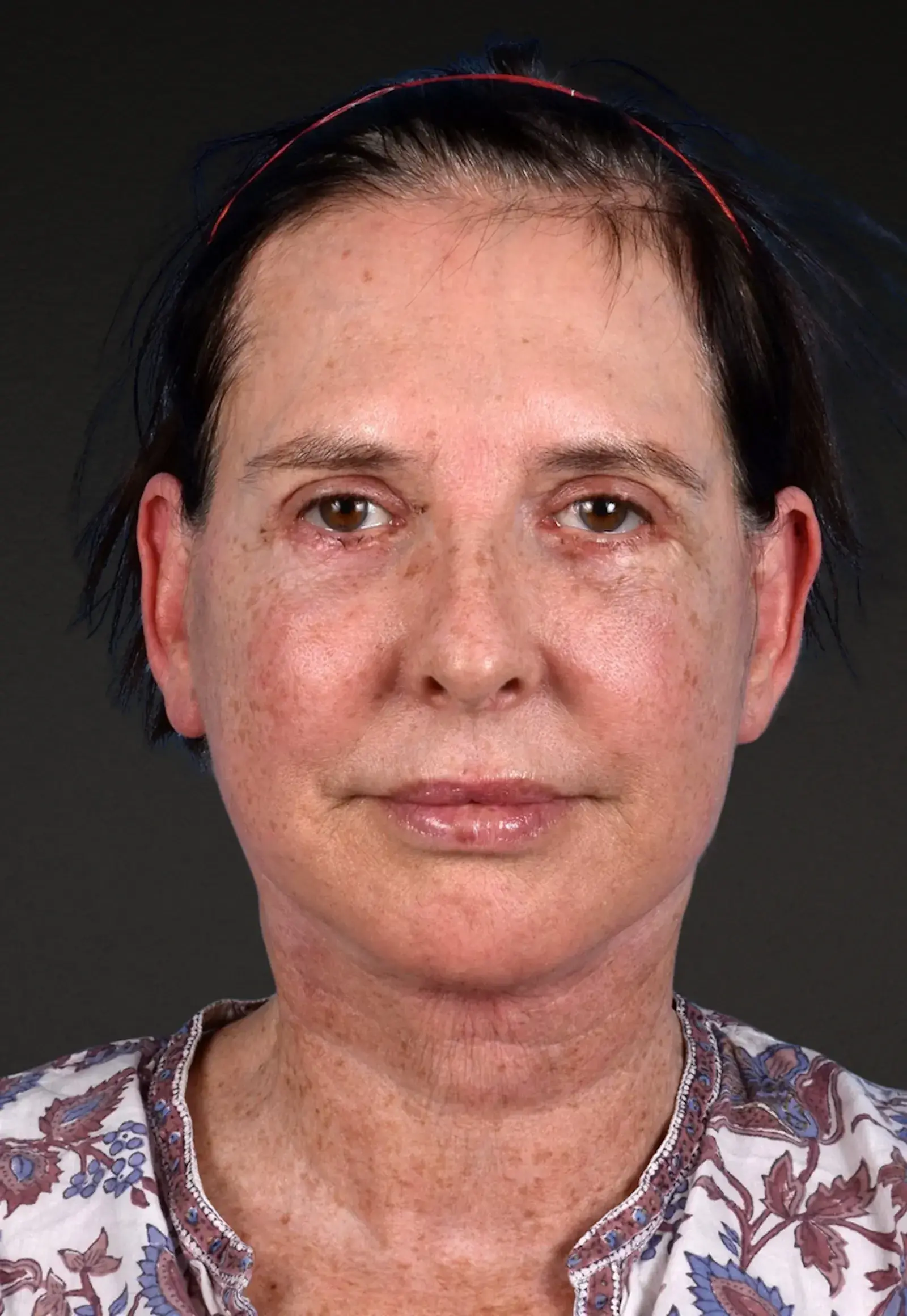 Cheng Plastic Surgery facelift after — Saratoga, CA