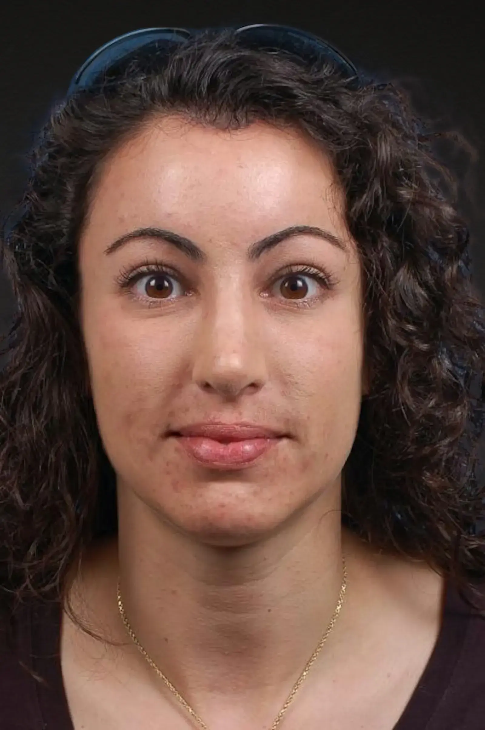 Cheng Plastic Surgery brow lift after — Saratoga, CA