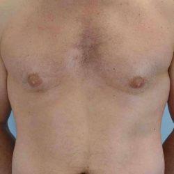 Gynecomastia Surgery after at Plastic Surgeon Cleveland: Dr. Paul Vanek in Concord, OH