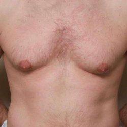 Gynecomastia Surgery before at Plastic Surgeon Cleveland: Dr. Paul Vanek in Concord, OH