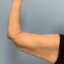 Arm Lift after at Plastic Surgeon Cleveland: Dr. Paul Vanek in Concord, OH