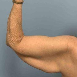 Arm Lift before at Plastic Surgeon Cleveland: Dr. Paul Vanek in Concord, OH