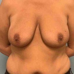 Breast Lift before at Plastic Surgeon Cleveland: Dr. Paul Vanek in Concord, OH