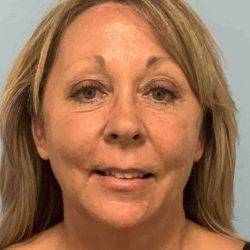 Blepharoplasty after at Plastic Surgeon Cleveland: Dr. Paul Vanek in Concord, OH