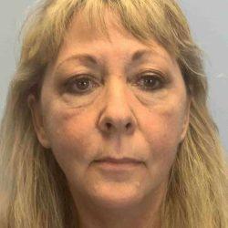 Blepharoplasty before at Plastic Surgeon Cleveland: Dr. Paul Vanek in Concord, OH