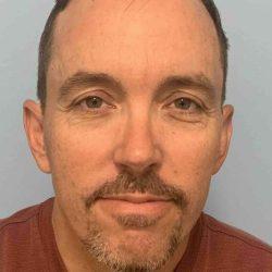 Plastic Surgeon Cleveland: Dr. Paul Vanek after — Concord, OH