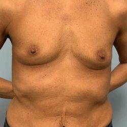 Breast Augmentation before at Plastic Surgeon Cleveland: Dr. Paul Vanek in Concord, OH