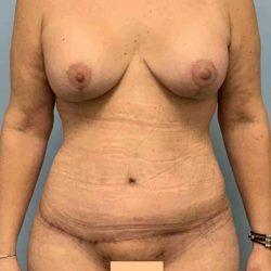 Mommy Makeover after at Plastic Surgeon Cleveland: Dr. Paul Vanek in Concord, OH
