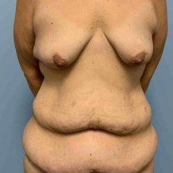 Mommy Makeover before at Plastic Surgeon Cleveland: Dr. Paul Vanek in Concord, OH