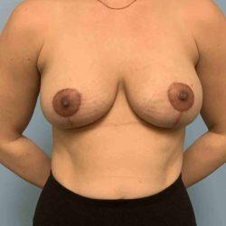 Breast Lift after at Plastic Surgeon Cleveland: Dr. Paul Vanek in Concord, OH