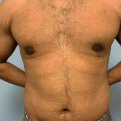 Gynecomastia Surgery after at Plastic Surgeon Cleveland: Dr. Paul Vanek in Concord, OH