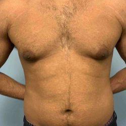 Gynecomastia Surgery before at Plastic Surgeon Cleveland: Dr. Paul Vanek in Concord, OH