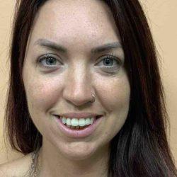 Lip Filler before at Plastic Surgeon Cleveland: Dr. Paul Vanek in Concord, OH