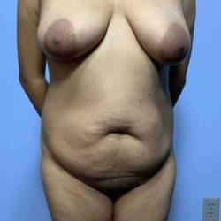 Mommy Makeover before at Plastic Surgeon Cleveland: Dr. Paul Vanek in Concord, OH