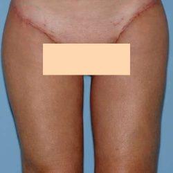 CoolSculpting after at Plastic Surgeon Cleveland: Dr. Paul Vanek in Concord, OH