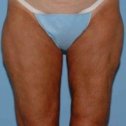CoolSculpting before at Plastic Surgeon Cleveland: Dr. Paul Vanek in Concord, OH