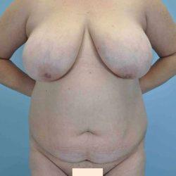 Mommy Makeover before at Plastic Surgeon Cleveland: Dr. Paul Vanek in Concord, OH
