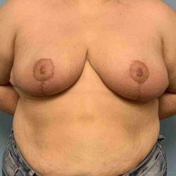 Breast Reduction after at Plastic Surgeon Cleveland: Dr. Paul Vanek in Concord, OH