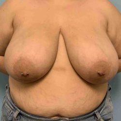 Breast Reduction before at Plastic Surgeon Cleveland: Dr. Paul Vanek in Concord, OH