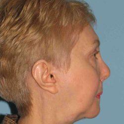 Plastic Surgeon Cleveland: Dr. Paul Vanek after — Concord, OH