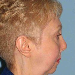 Facelift before at Plastic Surgeon Cleveland: Dr. Paul Vanek in Concord, OH