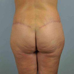 CoolSculpting after at Plastic Surgeon Cleveland: Dr. Paul Vanek in Concord, OH
