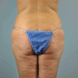 CoolSculpting before at Plastic Surgeon Cleveland: Dr. Paul Vanek in Concord, OH