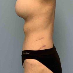 Mini Tummy Tuck after at Plastic Surgeon Cleveland: Dr. Paul Vanek in Concord, OH