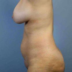 Mini Tummy Tuck before at Plastic Surgeon Cleveland: Dr. Paul Vanek in Concord, OH
