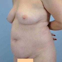 Mommy Makeover before at Plastic Surgeon Cleveland: Dr. Paul Vanek in Concord, OH