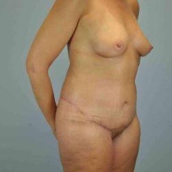 Tummy Tuck after at Plastic Surgeon Cleveland: Dr. Paul Vanek in Concord, OH