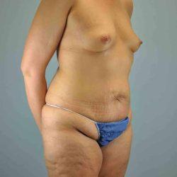 Tummy Tuck before at Plastic Surgeon Cleveland: Dr. Paul Vanek in Concord, OH