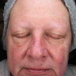 Plastic Surgeon Cleveland: Dr. Paul Vanek laser treatment after — Concord, OH