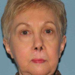 Blepharoplasty after at Plastic Surgeon Cleveland: Dr. Paul Vanek in Concord, OH
