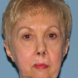 Blepharoplasty before at Plastic Surgeon Cleveland: Dr. Paul Vanek in Concord, OH
