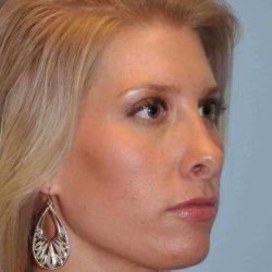Rhinoplasty after at Plastic Surgeon Cleveland: Dr. Paul Vanek in Concord, OH