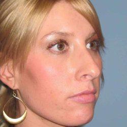 Rhinoplasty before at Plastic Surgeon Cleveland: Dr. Paul Vanek in Concord, OH