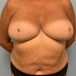 Breast Reduction after at Plastic Surgeon Cleveland: Dr. Paul Vanek in Concord, OH
