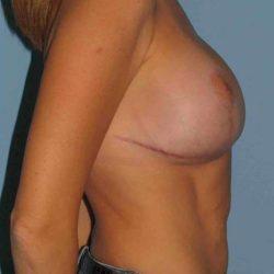 Mommy Makeover after at Plastic Surgeon Cleveland: Dr. Paul Vanek in Concord, OH